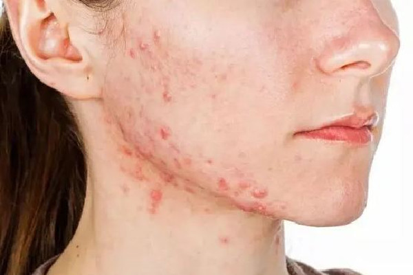 光谷瑞妮可思·科技抗衰中心修復(fù)肌膚效果怎么樣 修復(fù)肌膚屏障一般需要多久 光谷瑞妮可思·科技抗衰中心修復(fù)肌膚效果怎么樣 修復(fù)肌膚屏障一般需要多久