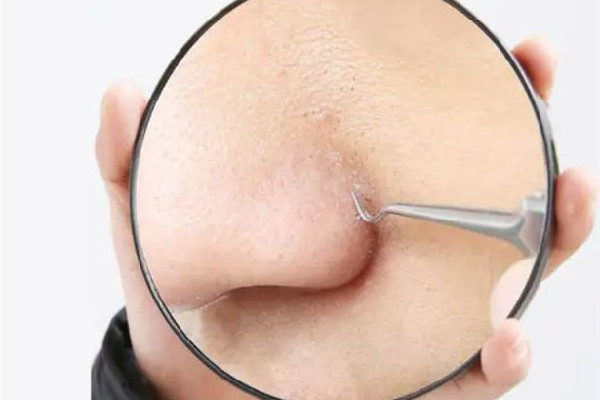 光谷思雨伊人美容養(yǎng)生店小氣泡去黑頭項目值得推薦嗎 小氣泡去黑頭幾次能干凈 光谷思雨伊人美容養(yǎng)生店小氣泡去黑頭項目值得推薦嗎 小氣泡去黑頭幾次能干凈