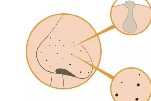 光谷EM輕松時刻科技美容店去黑頭效果怎么樣 去黑頭可以管多久 光谷EM輕松時刻科技美容店去黑頭效果怎么樣 去黑頭可以管多久