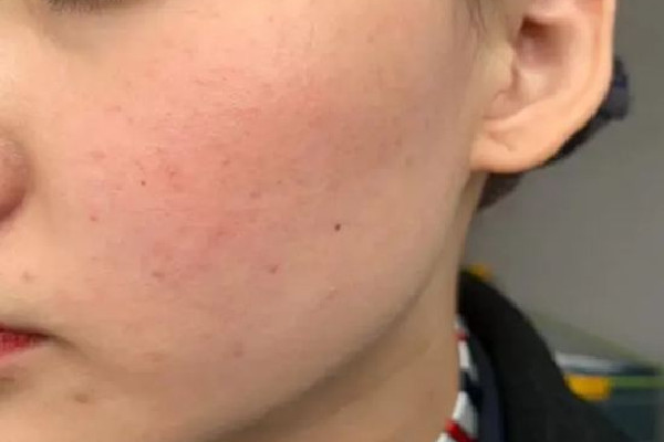 光谷MG問題皮膚管理中心痘痘肌護理怎么樣 痘痘肌膚適合什么面膜 光谷MG問題皮膚管理中心痘痘肌護理怎么樣 痘痘肌膚適合什么面膜