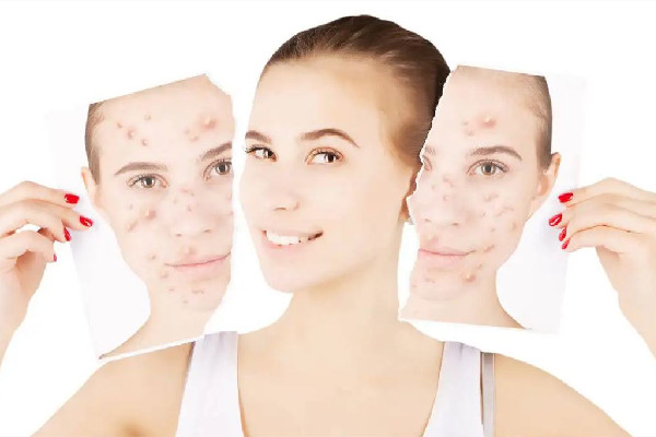 光谷MG問題皮膚管理中心痘痘肌護理怎么樣 痘痘肌膚適合什么面膜 光谷MG問題皮膚管理中心痘痘肌護理怎么樣 痘痘肌膚適合什么面膜