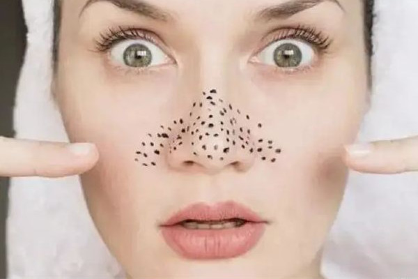 光谷天地傾顏皮膚管理中心去黑頭專業(yè)嗎 去黑頭會不會越來越嚴(yán)重 光谷天地傾顏皮膚管理中心去黑頭專業(yè)嗎 去黑頭會不會越來越嚴(yán)重