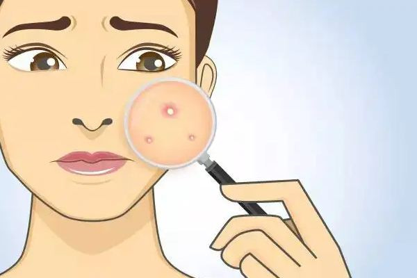 菱角湖SOR索爾祛痘?面部肌膚科學(xué)管理店祛痘效果怎么樣 祛痘是去醫(yī)院好還是美容院好 菱角湖SOR索爾祛痘?面部肌膚科學(xué)管理店祛痘效果怎么樣 祛痘是去醫(yī)院好還是美容院好