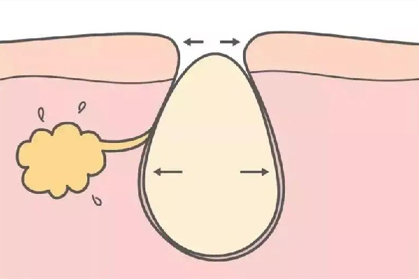 水果湖愛漾皮膚管理中心清潔毛孔后感覺怎么樣 清潔毛孔是去角質嗎 水果湖愛漾皮膚管理中心清潔毛孔后感覺怎么樣 清潔毛孔是去角質嗎