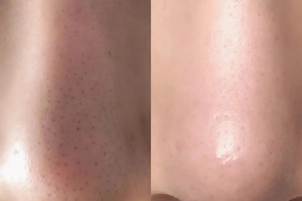 水果湖清顏堂專業(yè)祛痘去黑頭好嗎 去黑頭可以用鼻貼嗎 水果湖清顏堂專業(yè)祛痘去黑頭好嗎 去黑頭可以用鼻貼嗎