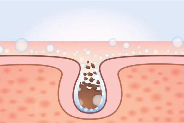 水果湖愛漾皮膚管理中心清潔毛孔后感覺怎么樣 清潔毛孔是去角質嗎 水果湖愛漾皮膚管理中心清潔毛孔后感覺怎么樣 清潔毛孔是去角質嗎