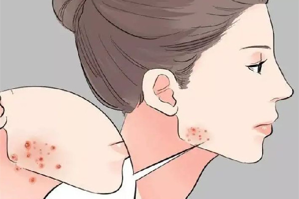 積玉橋vup·科技美膚·祛斑·祛痘連鎖痘痘肌護理怎么樣 痘痘肌用什洗面奶 積玉橋vup·科技美膚·祛斑·祛痘連鎖痘痘肌護理怎么樣 痘痘肌用什洗面奶