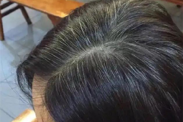 白頭發(fā)多是體內(nèi)缺少什么元素 白頭發(fā)補維生素b幾 白頭發(fā)多是體內(nèi)缺少什么元素 白頭發(fā)補維生素b幾