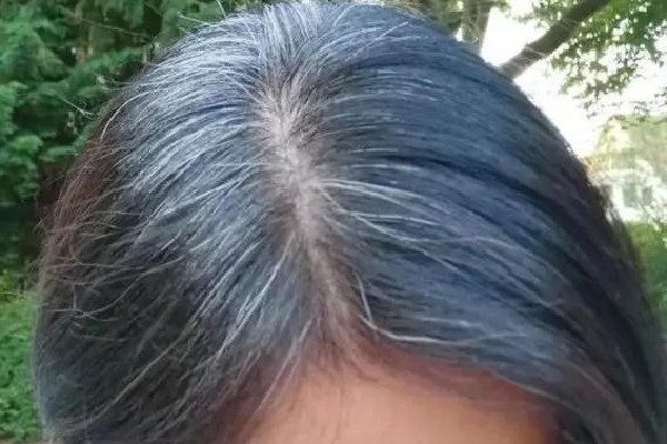 白頭發(fā)越來越多是身體哪里有問題 白頭發(fā)多和腎虛有關(guān)系嗎 白頭發(fā)越來越多是身體哪里有問題 白頭發(fā)多和腎虛有關(guān)系嗎