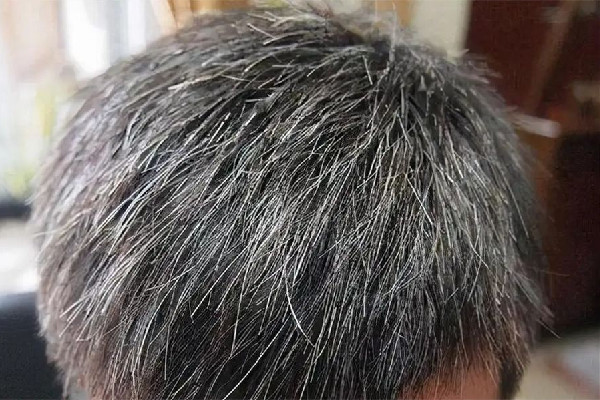 白頭發(fā)怎樣調(diào)理才能變黑 白頭發(fā)用白醋洗會(huì)變黑嗎 白頭發(fā)怎樣調(diào)理才能變黑 白頭發(fā)用白醋洗會(huì)變黑嗎