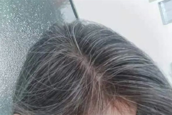 白頭發(fā)和性生活頻繁有關(guān)系嗎 白頭發(fā)是腎陰虛還是腎陽虛 白頭發(fā)和性生活頻繁有關(guān)系嗎 白頭發(fā)是腎陰虛還是腎陽虛