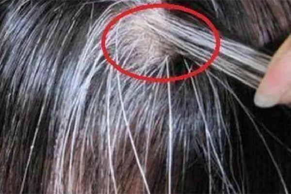 白頭發(fā)和性生活頻繁有關(guān)系嗎 白頭發(fā)是腎陰虛還是腎陽虛 白頭發(fā)和性生活頻繁有關(guān)系嗎 白頭發(fā)是腎陰虛還是腎陽虛