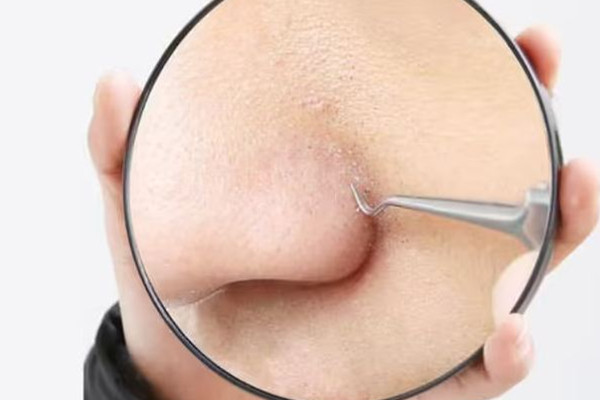 中南路skin79皮膚管理中心去黑頭去的干凈嗎 去黑頭可以用什么 中南路skin79皮膚管理中心去黑頭去的干凈嗎 去黑頭可以用什么