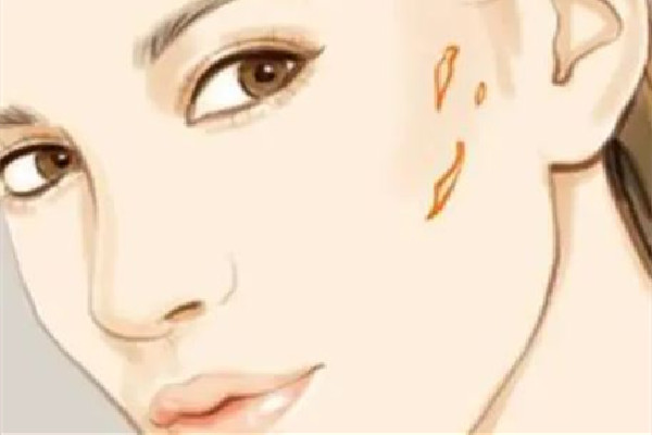 中南路正璞醫(yī)療美容·痘坑疤痕&皮膚微整店祛疤效果怎么樣 祛疤會(huì)越來越嚴(yán)重嗎 中南路正璞醫(yī)療美容·痘坑疤痕&皮膚微整店祛疤效果怎么樣 祛疤會(huì)越來越嚴(yán)重嗎