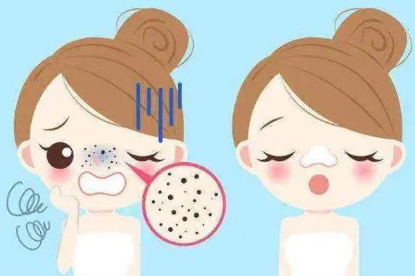 中南路MY科技纖體美膚連鎖店改善黑頭項(xiàng)目做完后怎么樣 改善黑頭粉刺的方法 中南路MY科技纖體美膚連鎖店改善黑頭項(xiàng)目做完后怎么樣 改善黑頭粉刺的方法