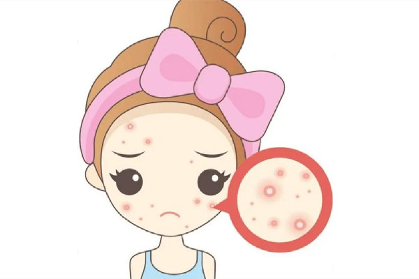 中南路蕾特恩專業(yè)祛痘·面部皮膚管理店痘痘肌護(hù)理好嗎 痘痘肌要一輩子忌口嗎 中南路蕾特恩專業(yè)祛痘·面部皮膚管理店痘痘肌護(hù)理好嗎 痘痘肌要一輩子忌口嗎