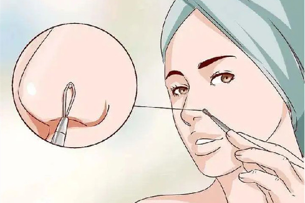 中南路蕾特恩專業(yè)祛痘·面部皮膚管理店去黑頭后效果怎么樣 去黑頭后怎么護理 中南路蕾特恩專業(yè)祛痘·面部皮膚管理店去黑頭后效果怎么樣 去黑頭后怎么護理