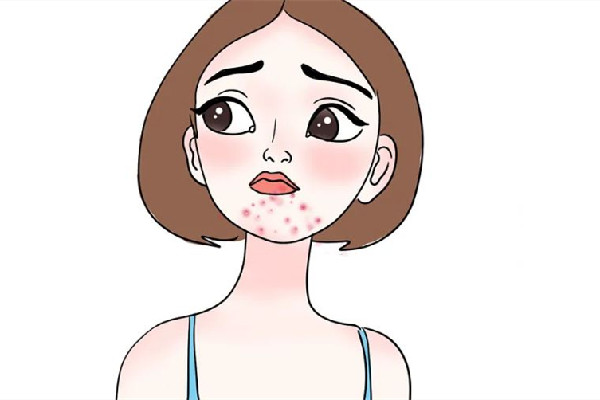 中南路痘醫(yī)堂祛痘祛斑皮膚管理中心痘肌護(hù)理好不好 痘肌不能吃什么食物 中南路痘醫(yī)堂祛痘祛斑皮膚管理中心痘肌護(hù)理好不好 痘肌不能吃什么食物