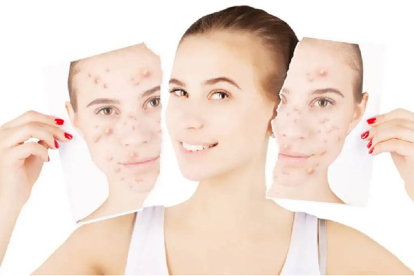 中南路夢都?巴厘女子SPA養(yǎng)生會所痘肌清理怎么樣 痘痘肌做小氣泡有用嗎 中南路夢都?巴厘女子SPA養(yǎng)生會所痘肌清理怎么樣 痘痘肌做小氣泡有用嗎