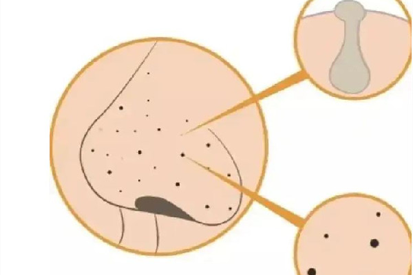 中南路美尚美容美體連鎖機構鼻頭清潔干凈嗎 有黑頭粉刺用什么洗面奶 中南路美尚美容美體連鎖機構鼻頭清潔干凈嗎 有黑頭粉刺用什么洗面奶