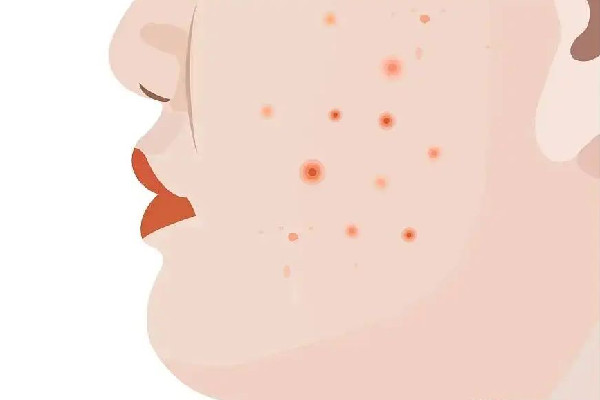 中南路Comely Lady美學中心店痘肌清潔怎么樣 痘肌多久用一次清潔面膜 中南路Comely Lady美學中心店痘肌清潔怎么樣 痘肌多久用一次清潔面膜