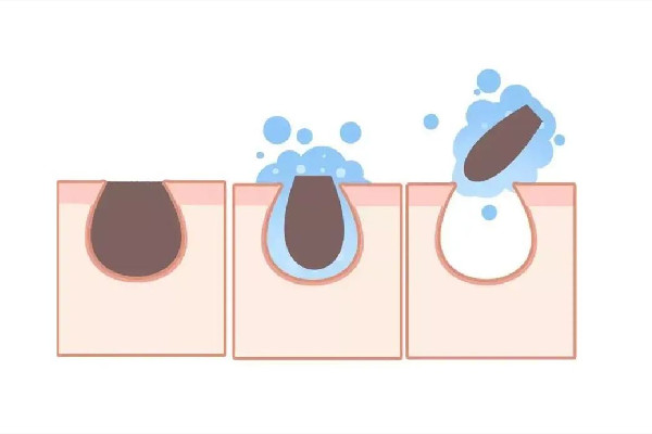 中南路美尚美容美體連鎖機構鼻頭清潔干凈嗎 有黑頭粉刺用什么洗面奶 中南路美尚美容美體連鎖機構鼻頭清潔干凈嗎 有黑頭粉刺用什么洗面奶