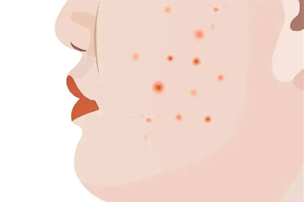 后湖SOR索爾祛痘?面部肌膚科學管理痘肌清潔做的怎么樣 痘肌怎么清潔皮膚 后湖SOR索爾祛痘?面部肌膚科學管理痘肌清潔做的怎么樣 痘肌怎么清潔皮膚