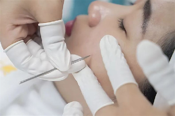 后湖SOR索爾祛痘?面部肌膚科學(xué)管理針清效果怎么樣 針清會(huì)讓毛孔變大嗎 后湖SOR索爾祛痘?面部肌膚科學(xué)管理針清效果怎么樣 針清會(huì)讓毛孔變大嗎