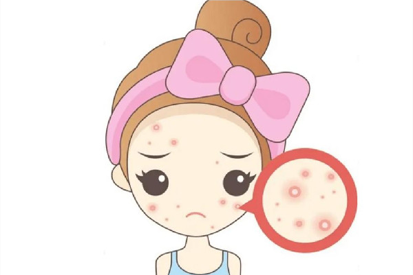 后湖SOR索爾祛痘?面部肌膚科學管理痘肌清潔做的怎么樣 痘肌怎么清潔皮膚 后湖SOR索爾祛痘?面部肌膚科學管理痘肌清潔做的怎么樣 痘肌怎么清潔皮膚