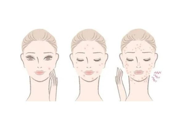 后湖SOR索爾祛痘?面部肌膚科學管理痘肌清潔做的怎么樣 痘肌怎么清潔皮膚 后湖SOR索爾祛痘?面部肌膚科學管理痘肌清潔做的怎么樣 痘肌怎么清潔皮膚