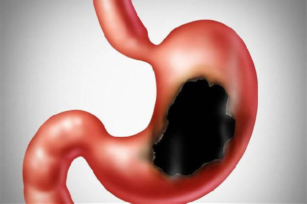 為什么年輕人胃病高發(fā) 胃病有什么癥狀及表現(xiàn) 為什么年輕人胃病高發(fā) 胃病有什么癥狀及表現(xiàn)