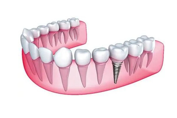 多地調(diào)低種植牙醫(yī)療服務費用 種牙醫(yī)保能報銷嗎 多地調(diào)低種植牙醫(yī)療服務費用 種牙醫(yī)保能報銷嗎