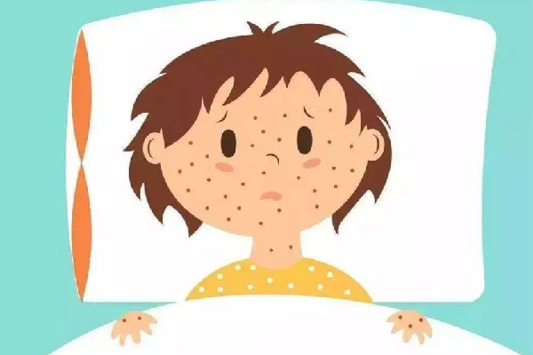 水痘進(jìn)入高發(fā)期專家提醒 水痘的癥狀和治療 水痘進(jìn)入高發(fā)期專家提醒 水痘的癥狀和治療