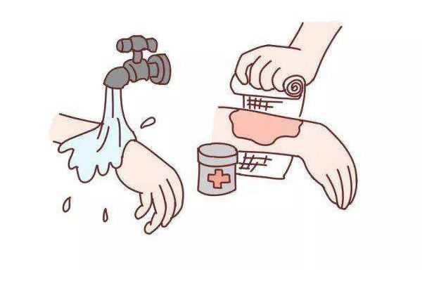 男子照顧大面積燒傷女友6年 大面積燒傷要多長時間才會恢復(fù) 男子照顧大面積燒傷女友6年 大面積燒傷要多長時間才會恢復(fù)