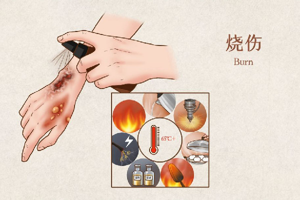 男子照顧大面積燒傷女友6年 大面積燒傷要多長時間才會恢復(fù) 男子照顧大面積燒傷女友6年 大面積燒傷要多長時間才會恢復(fù)